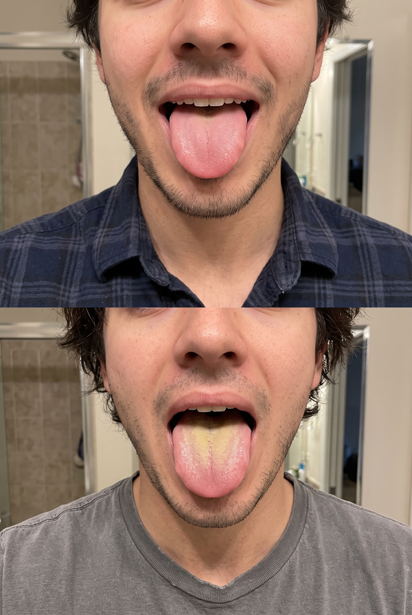 Bad Breath & Tongue Build-up — Ralph