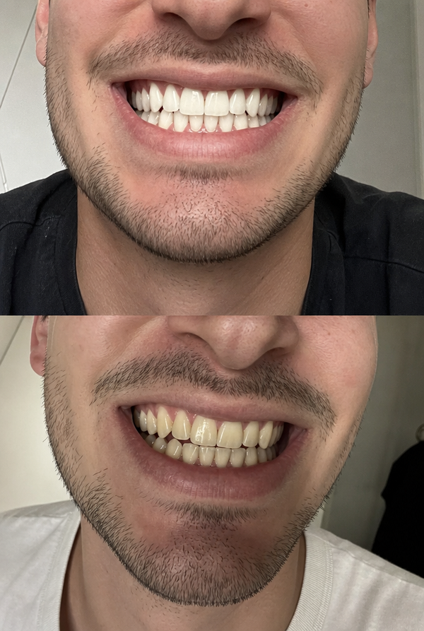 Yellow Teeth — Craig